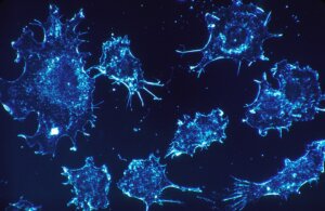 California Doctor Opens a New Front in Cancer War